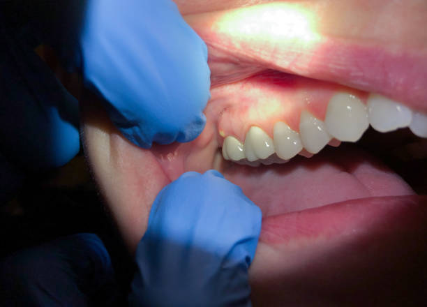 Best Emergency Care for Gum Disease in Menomonee Falls, WI